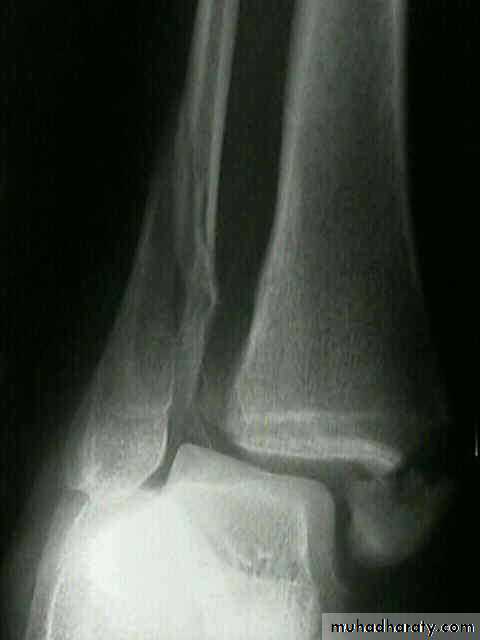 Fractures shaft tibia and fibula