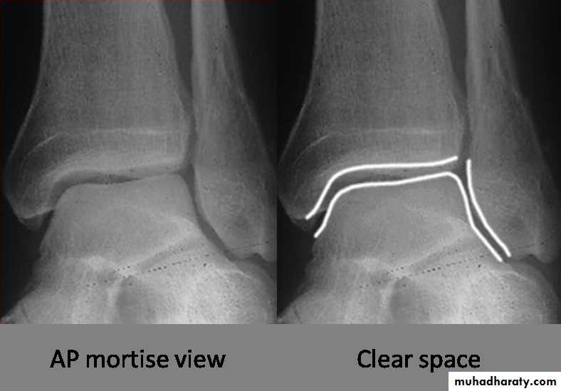 Fractures shaft tibia and fibula
