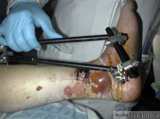 Fractures shaft tibia and fibula