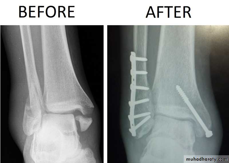 Fractures shaft tibia and fibula