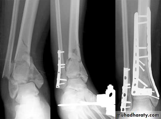 Fractures shaft tibia and fibula