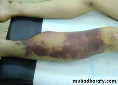 Fractures shaft tibia and fibula