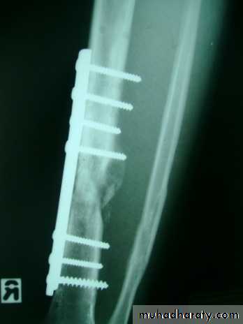 Fractures shaft tibia and fibula