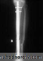 Fractures shaft tibia and fibula