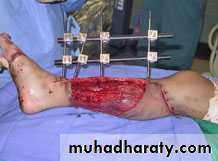 Fractures shaft tibia and fibula