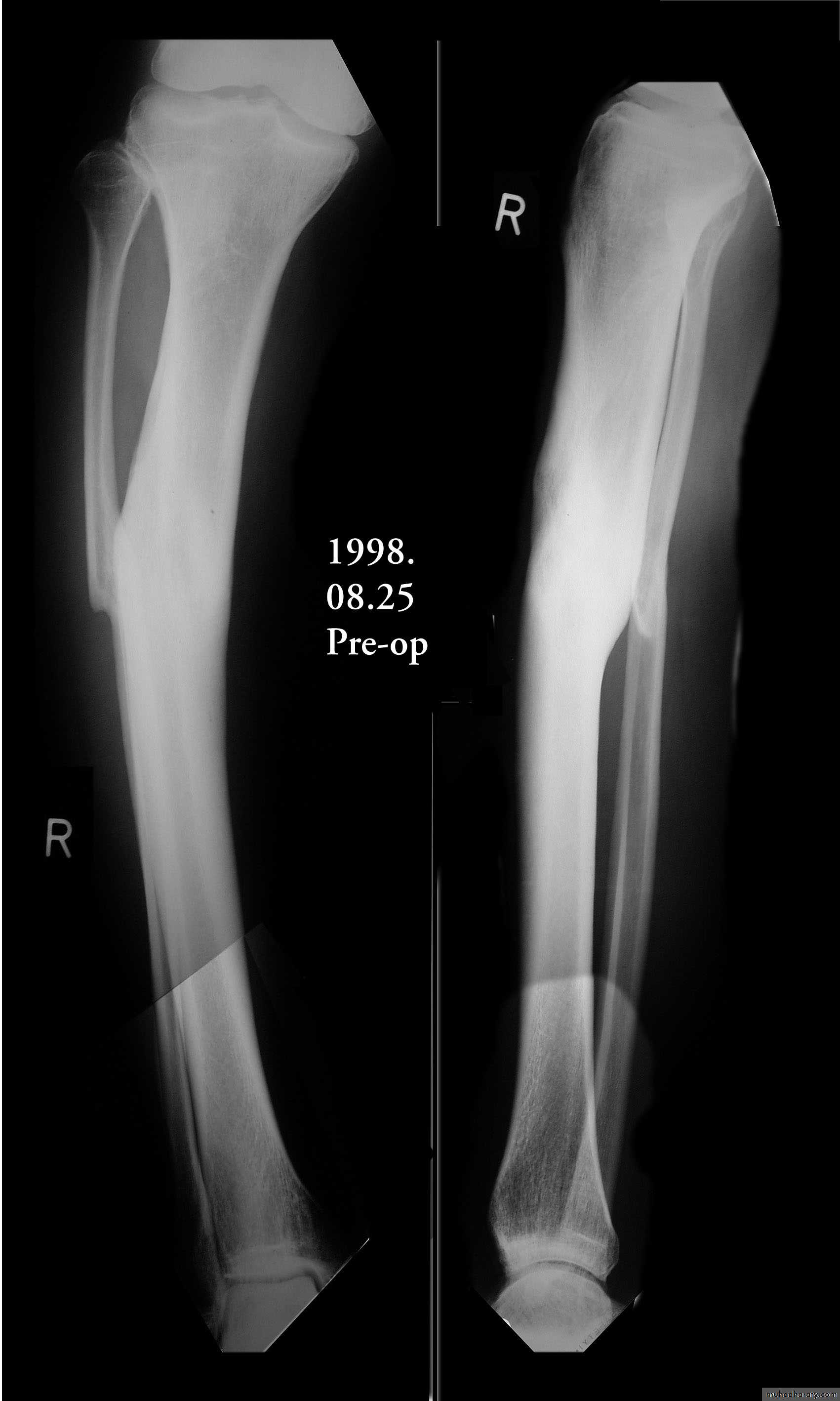 Fractures shaft tibia and fibula