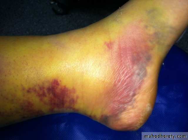 Fractures shaft tibia and fibula