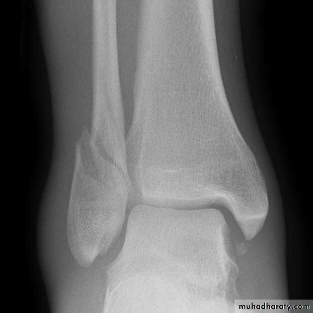 Fractures shaft tibia and fibula
