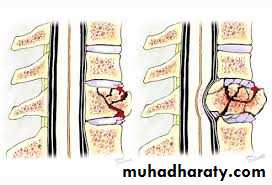 frcature spine and peripheral nerve