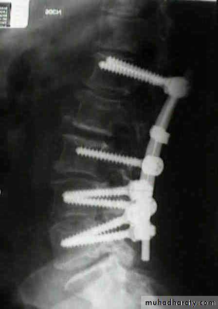 frcature spine and peripheral nerve