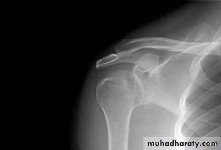 frcature spine and peripheral nerve