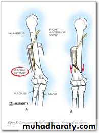 frcature spine and peripheral nerve