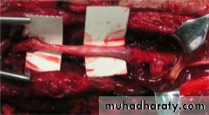 frcature spine and peripheral nerve