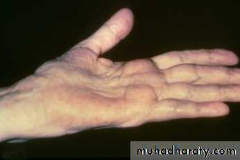 frcature spine and peripheral nerve