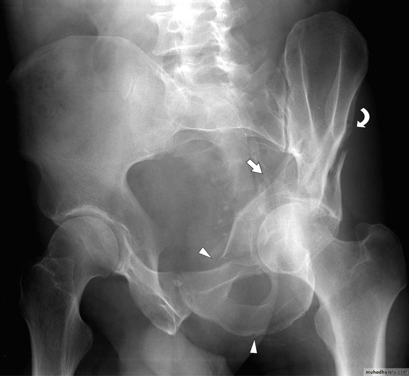 frcature spine and peripheral nerve