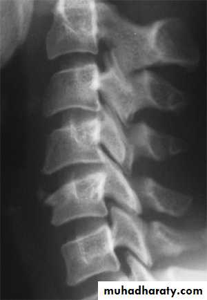 frcature spine and peripheral nerve