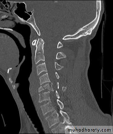 frcature spine and peripheral nerve