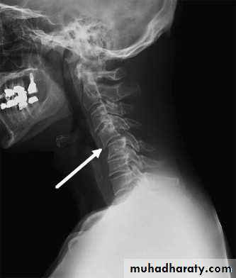 frcature spine and peripheral nerve