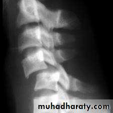 frcature spine and peripheral nerve
