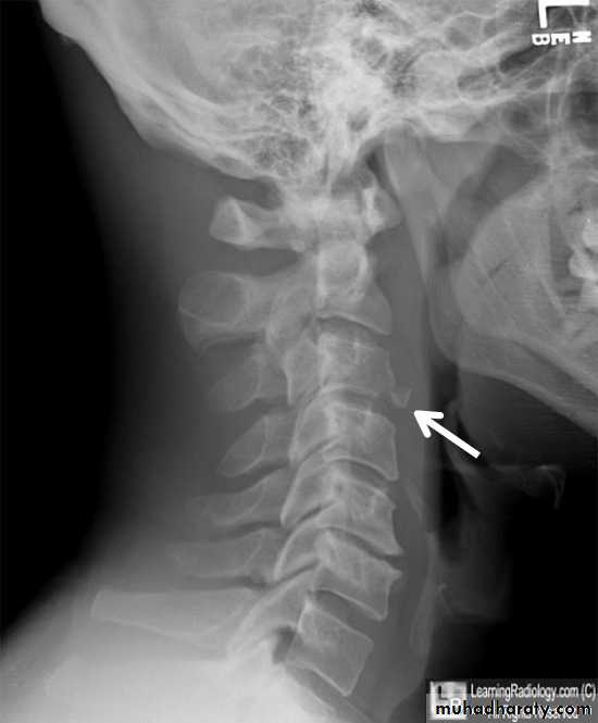 frcature spine and peripheral nerve