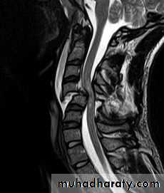 frcature spine and peripheral nerve