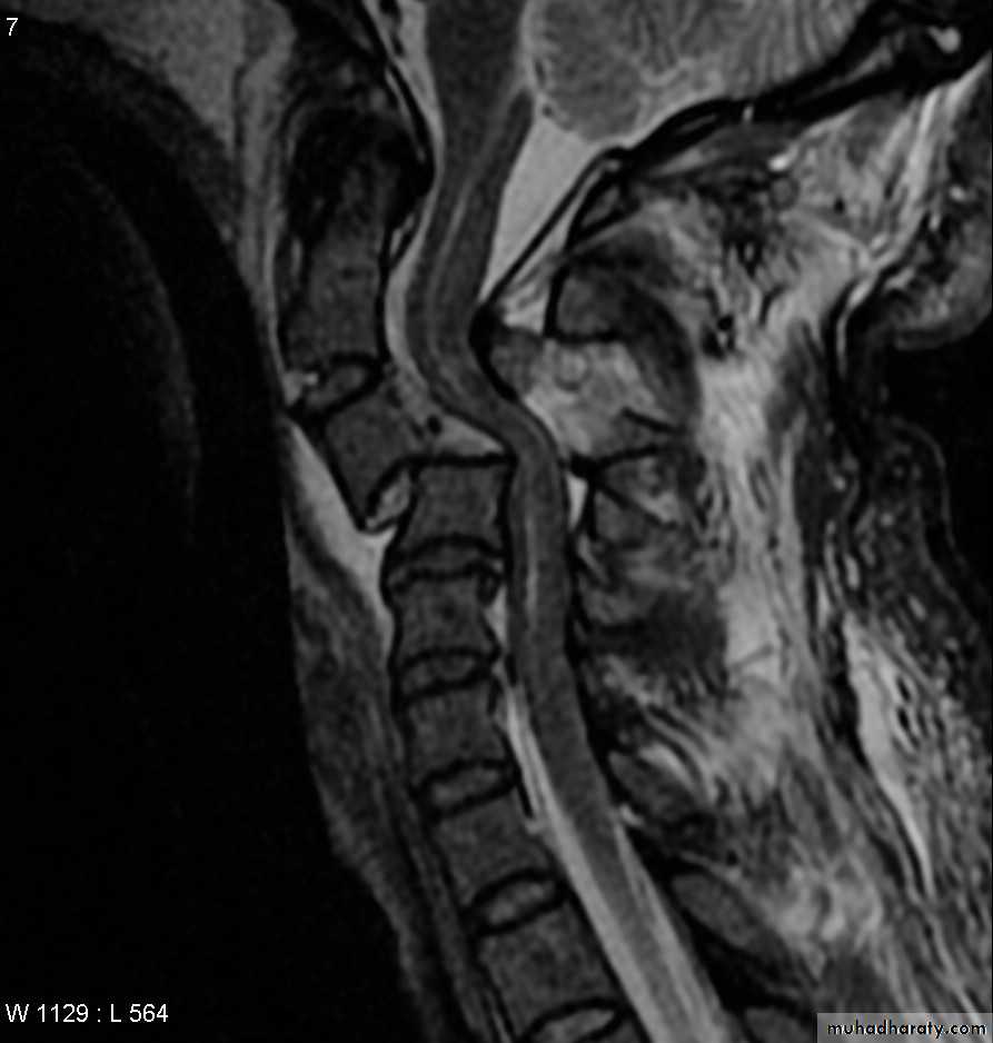 frcature spine and peripheral nerve