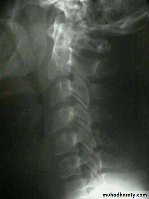 frcature spine and peripheral nerve