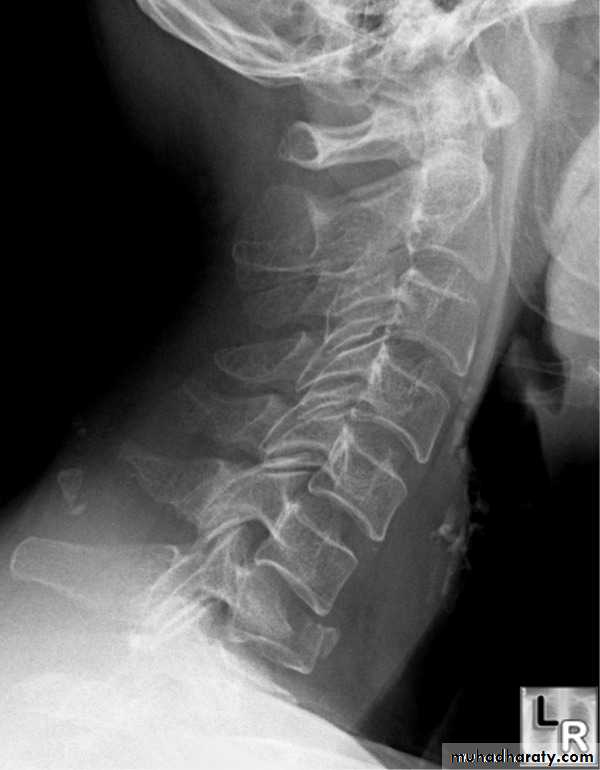frcature spine and peripheral nerve
