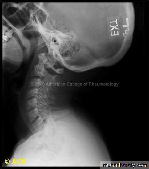 frcature spine and peripheral nerve