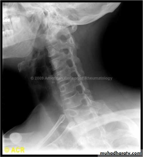 frcature spine and peripheral nerve