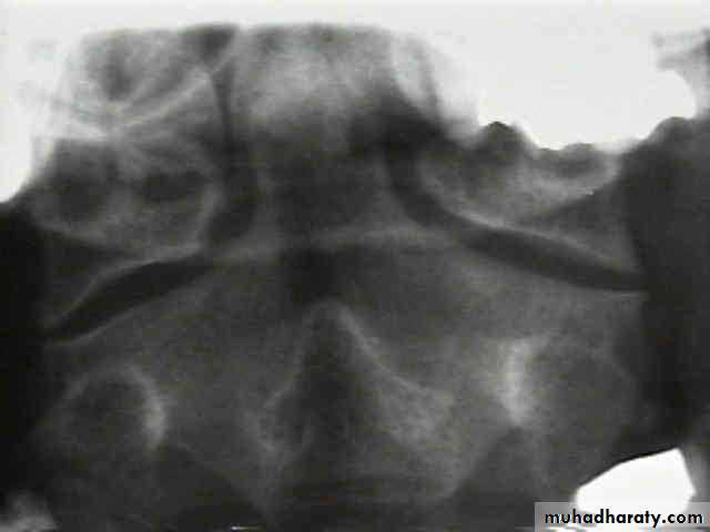 frcature spine and peripheral nerve