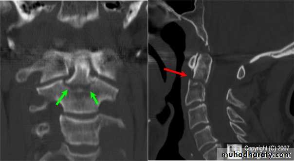 frcature spine and peripheral nerve