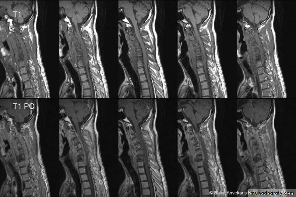 frcature spine and peripheral nerve