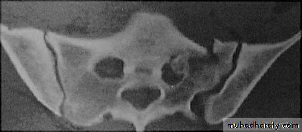 frcature spine and peripheral nerve