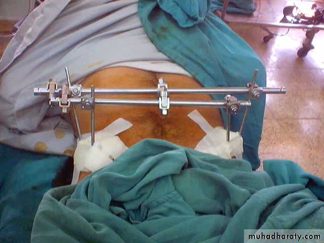 pelvic_fracture