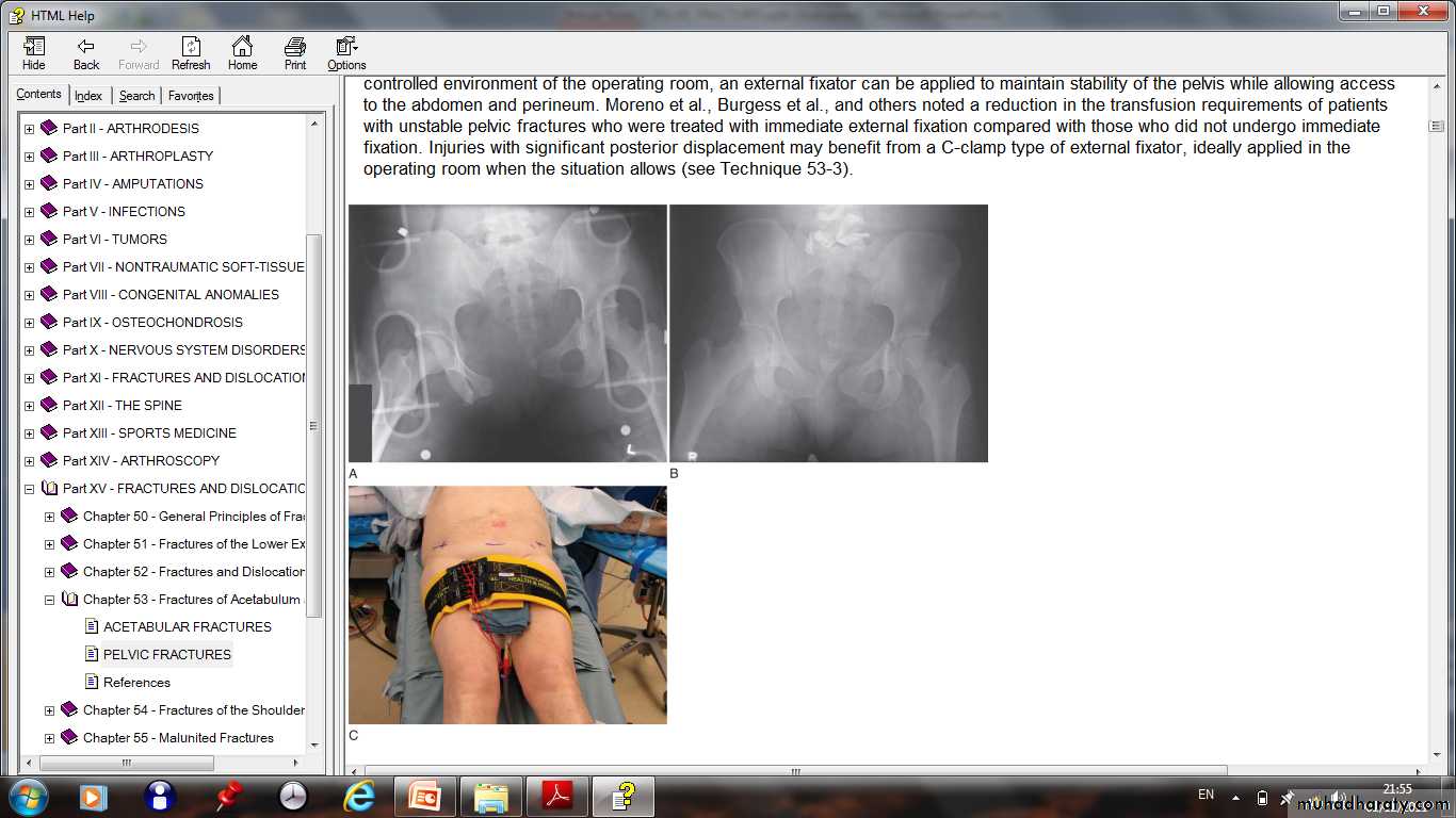 pelvic_fracture