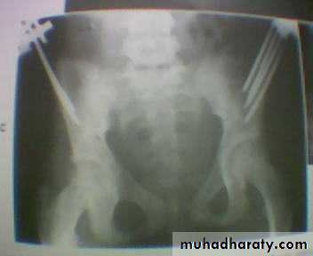 pelvic_fracture