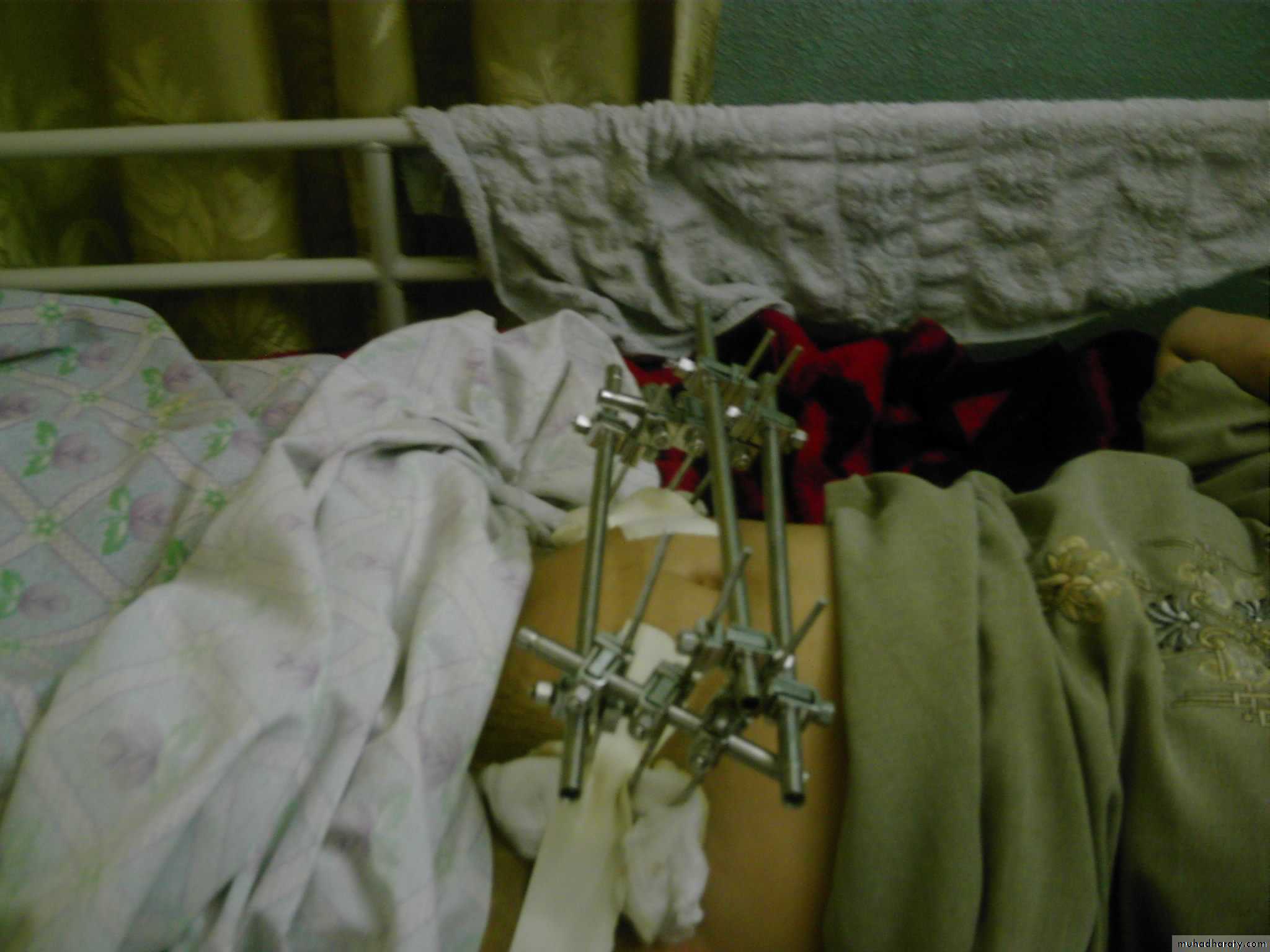 pelvic_fracture