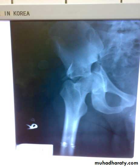 pelvic_fracture