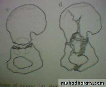 pelvic_fracture