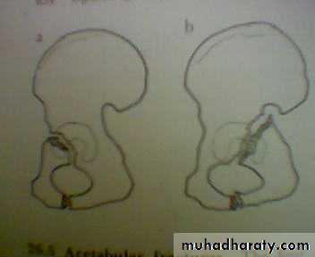 pelvic_fracture