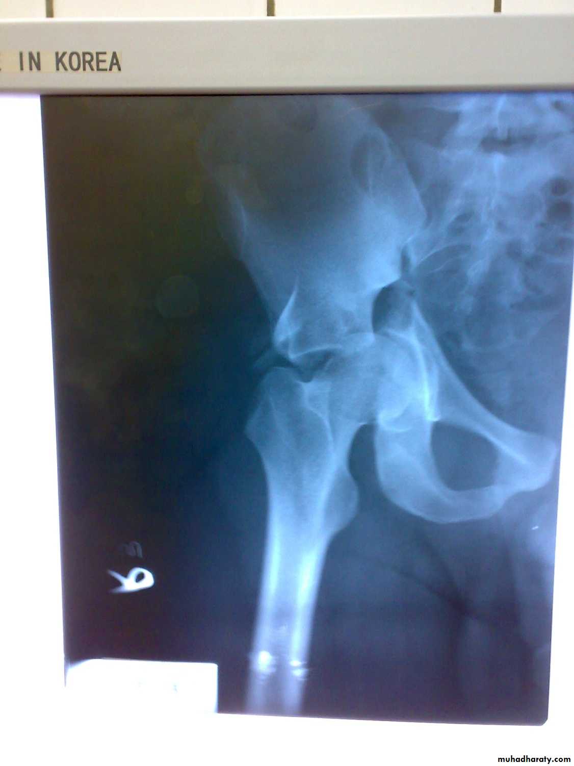 pelvic_fracture