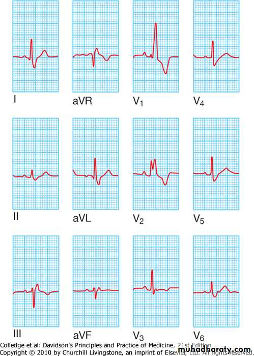 2 THE 12 LEADS STNDARD ECG