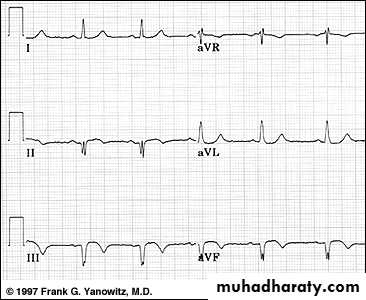 2 THE 12 LEADS STNDARD ECG
