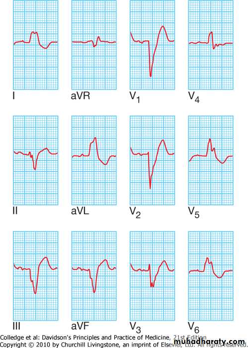 2 THE 12 LEADS STNDARD ECG