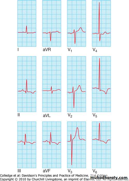 2 THE 12 LEADS STNDARD ECG