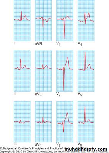 2 THE 12 LEADS STNDARD ECG