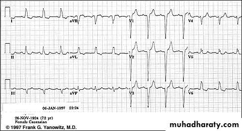 2 THE 12 LEADS STNDARD ECG