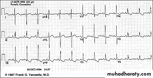 2 THE 12 LEADS STNDARD ECG