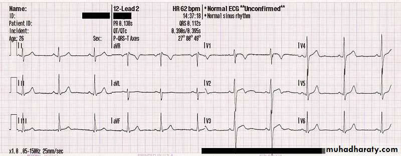 2 THE 12 LEADS STNDARD ECG